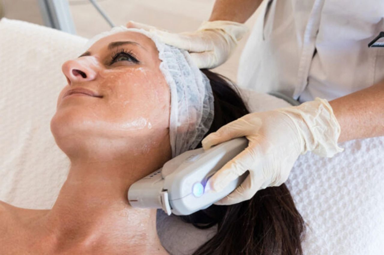 Manipolo HIFU sul viso di una cliente durante il trattamento lifting