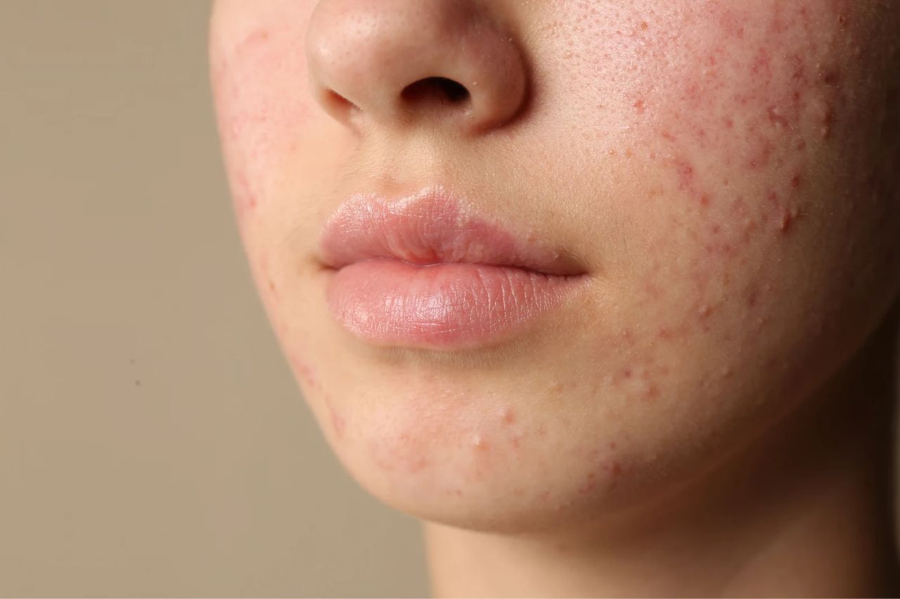 Primo piano di guancia e mento con segni di acne
